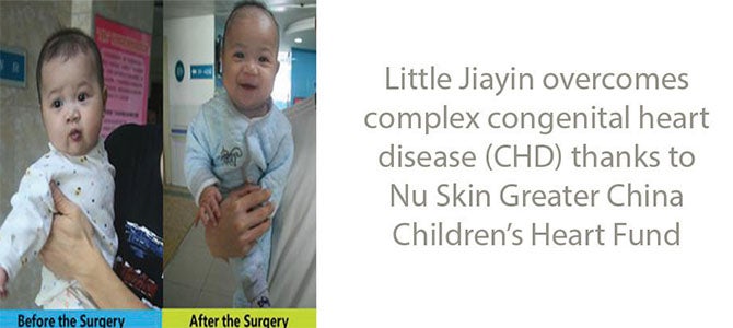 Baby's Life Saved From Heart Disease Little Jiayin overcomes complex congenital heart disease (CHD) thanks to Nu Skin Greater China Children's Heart Fund.